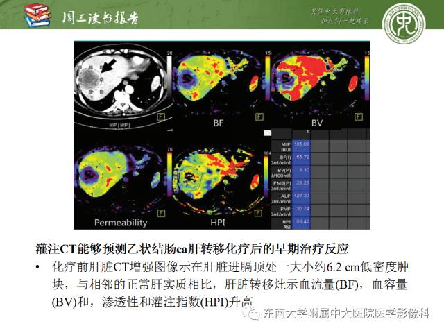 【PPT】肝脏CT灌注在肿瘤学中的原理及应用