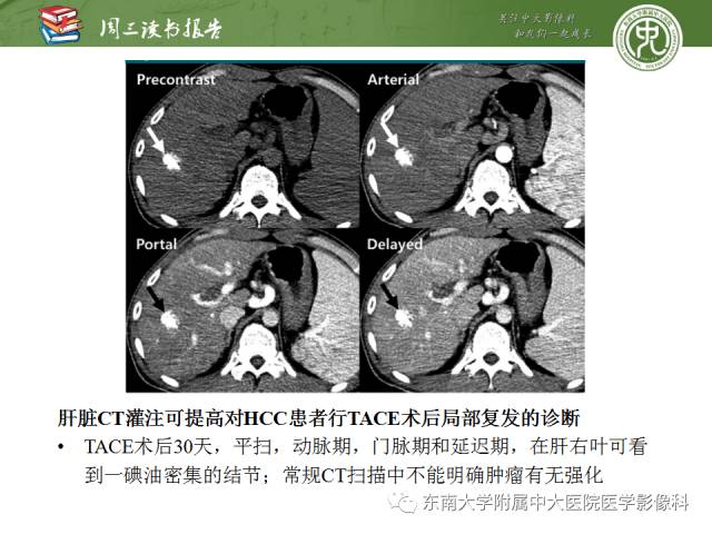 【PPT】肝脏CT灌注在肿瘤学中的原理及应用