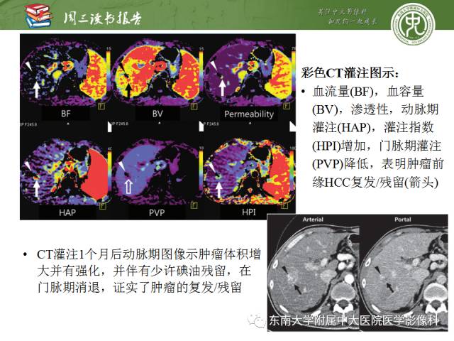 【PPT】肝脏CT灌注在肿瘤学中的原理及应用