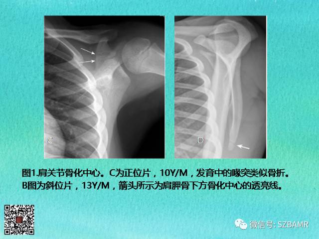 【PPT】儿童骨肌发育变异的影像学诊断