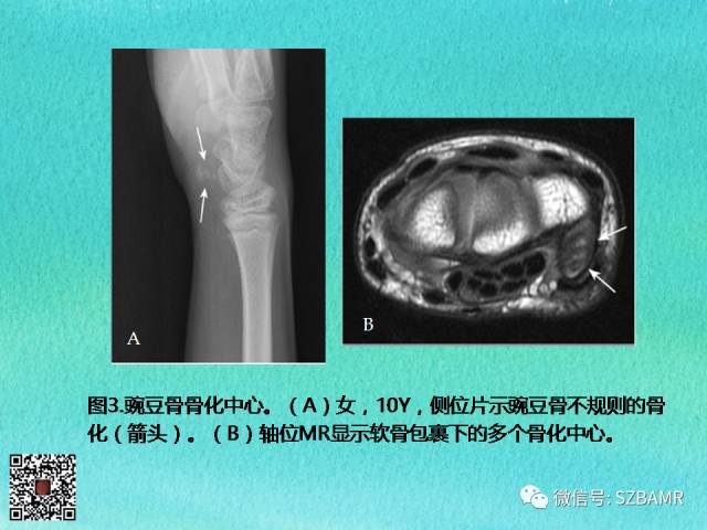 【PPT】儿童骨肌发育变异的影像学诊断