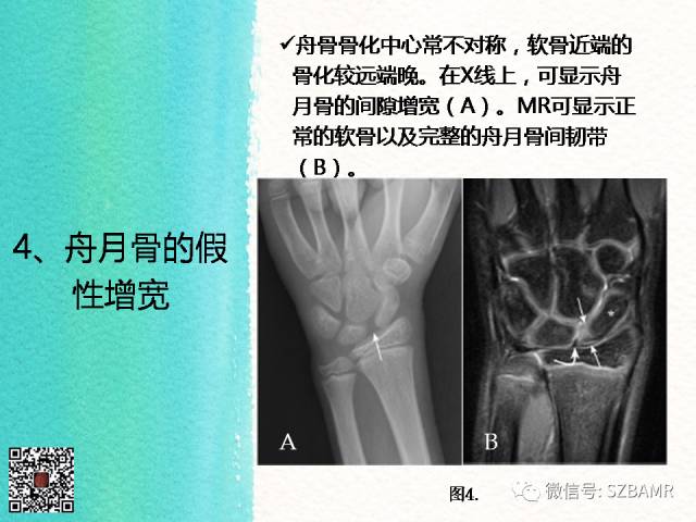 【PPT】儿童骨肌发育变异的影像学诊断