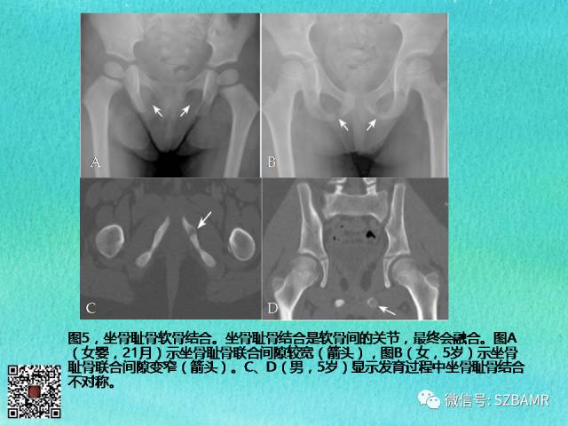 【PPT】儿童骨肌发育变异的影像学诊断