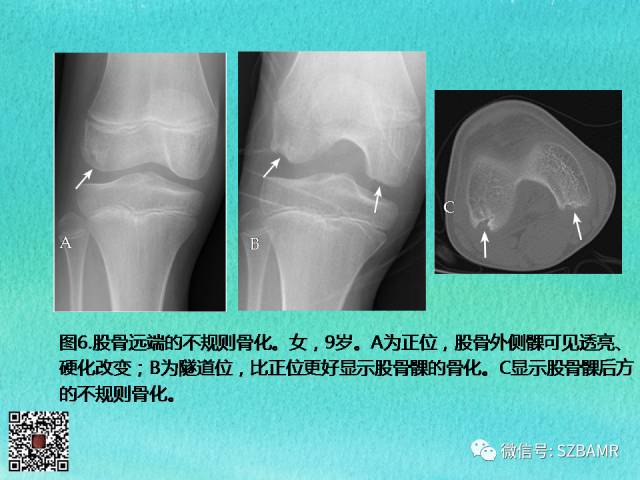【PPT】儿童骨肌发育变异的影像学诊断