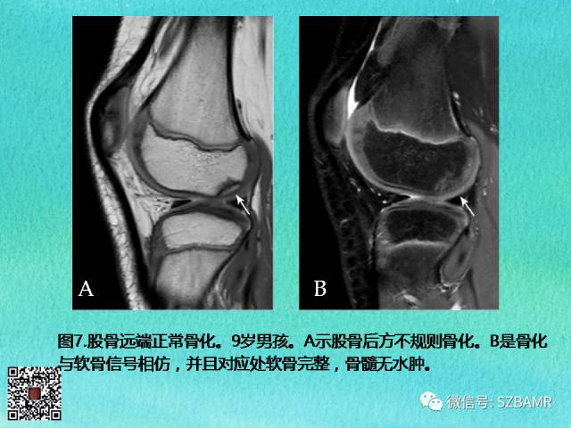 【PPT】儿童骨肌发育变异的影像学诊断
