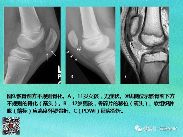 【PPT】儿童骨肌发育变异的影像学诊断