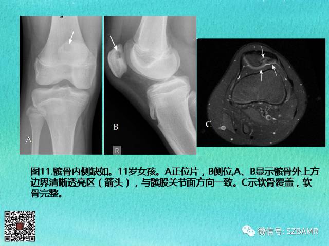 【PPT】儿童骨肌发育变异的影像学诊断
