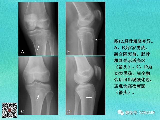 【PPT】儿童骨肌发育变异的影像学诊断