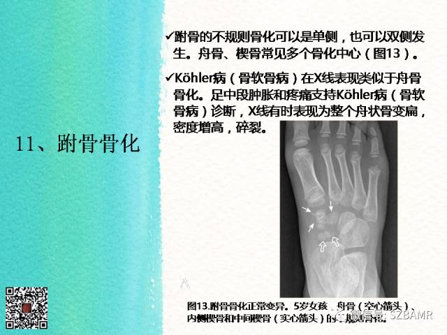 【PPT】儿童骨肌发育变异的影像学诊断