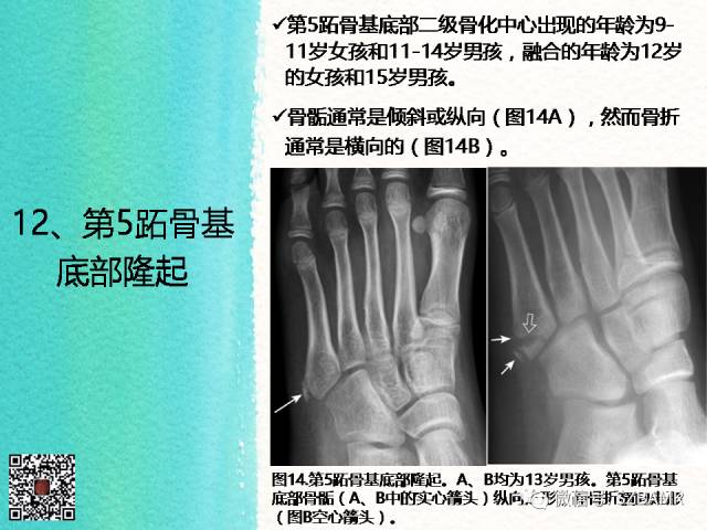 【PPT】儿童骨肌发育变异的影像学诊断