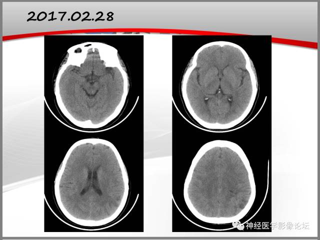 【病例】线粒体脑肌病典型病例一例MR 【病例】线粒体脑肌病典型病例一例MR