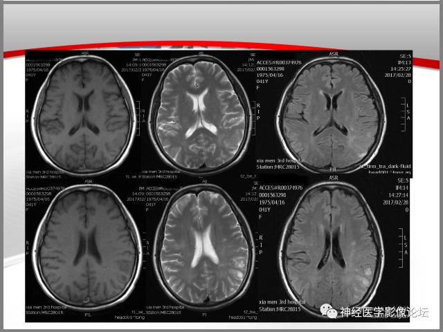 【病例】线粒体脑肌病典型病例一例MR 【病例】线粒体脑肌病典型病例一例MR