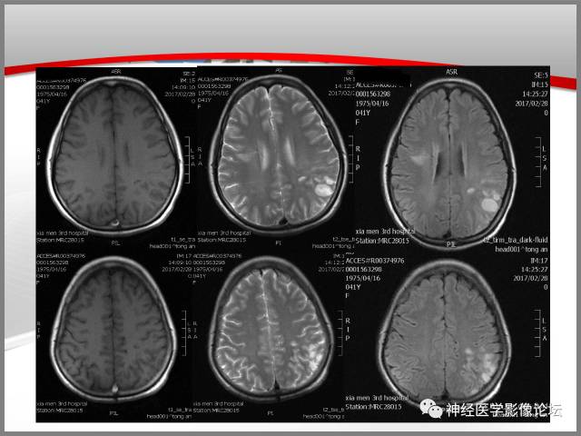 【病例】线粒体脑肌病典型病例一例MR 【病例】线粒体脑肌病典型病例一例MR