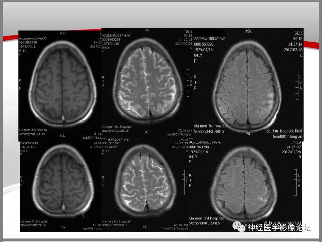 【病例】线粒体脑肌病典型病例一例MR 【病例】线粒体脑肌病典型病例一例MR
