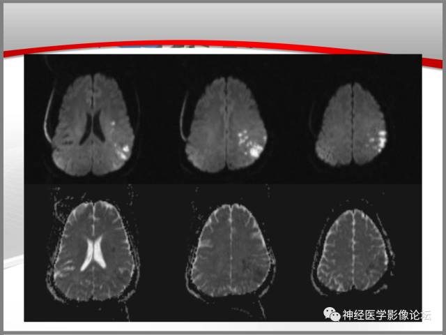 【病例】线粒体脑肌病典型病例一例MR 【病例】线粒体脑肌病典型病例一例MR