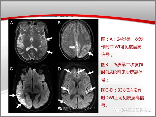【病例】线粒体脑肌病典型病例一例MR 【病例】线粒体脑肌病典型病例一例MR