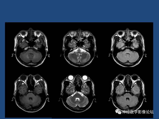 【病例】线粒体脑肌病疑难病例一例MR影像讨论
