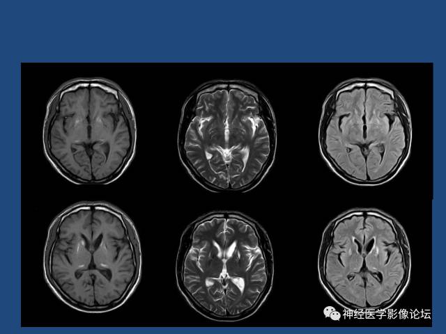 【病例】线粒体脑肌病疑难病例一例MR影像讨论