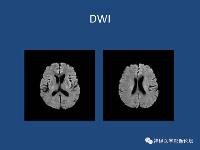 【病例】线粒体脑肌病疑难病例一例MR影像讨论