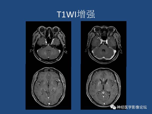 【病例】线粒体脑肌病疑难病例一例MR影像讨论