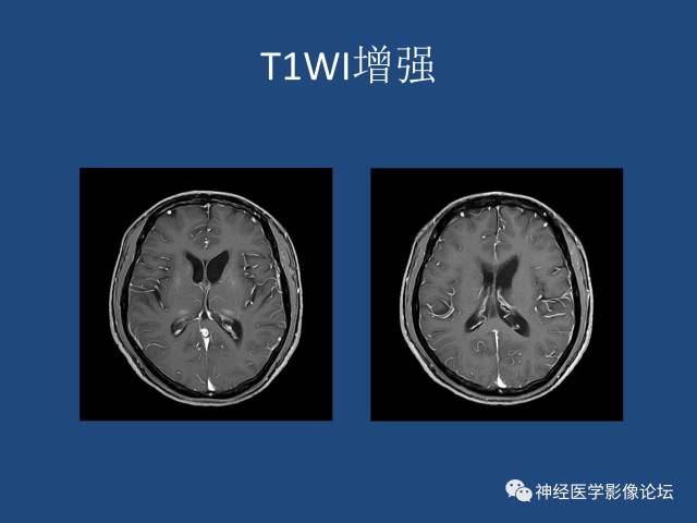 【病例】线粒体脑肌病疑难病例一例MR影像讨论
