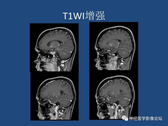 【病例】线粒体脑肌病疑难病例一例MR影像讨论