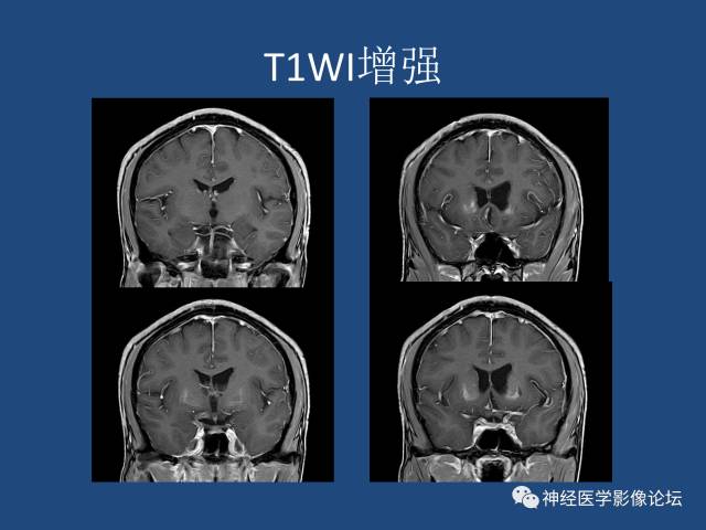 【病例】线粒体脑肌病疑难病例一例MR影像讨论