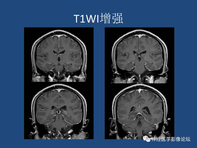 【病例】线粒体脑肌病疑难病例一例MR影像讨论