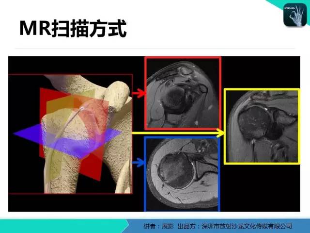 【PPT】肩峰下撞击综合征和肩袖损伤的MR表现