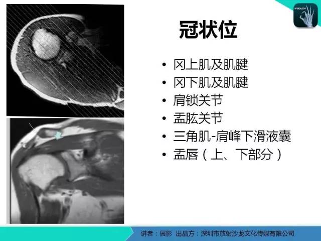【PPT】肩峰下撞击综合征和肩袖损伤的MR表现