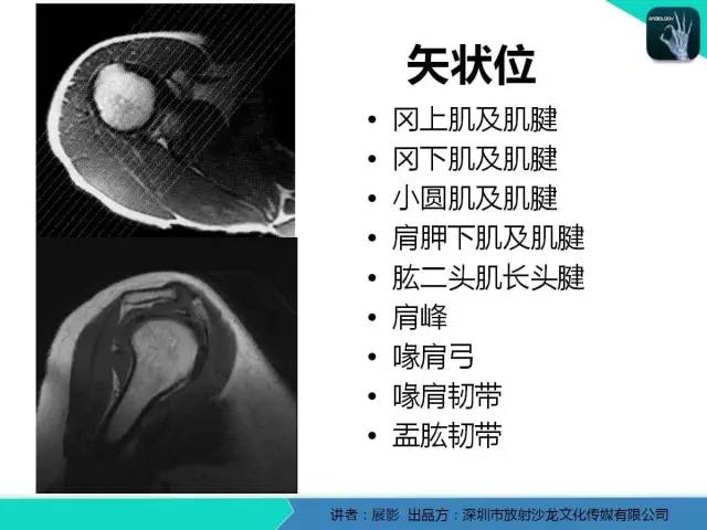 【PPT】肩峰下撞击综合征和肩袖损伤的MR表现