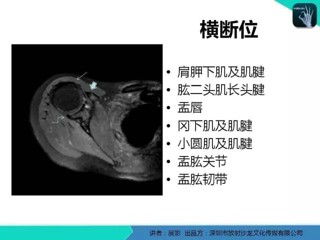 【PPT】肩峰下撞击综合征和肩袖损伤的MR表现