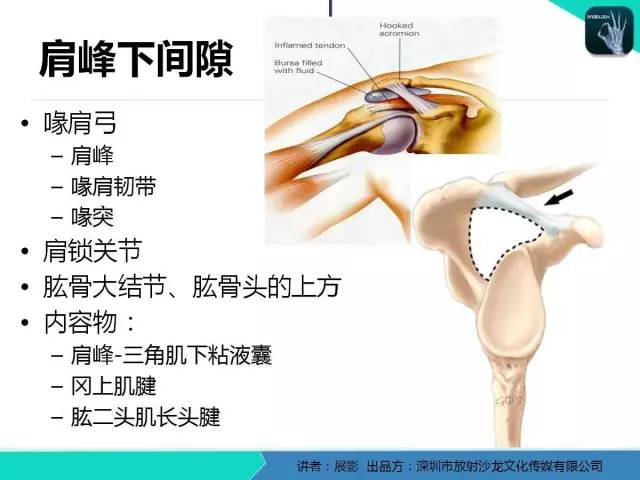 【PPT】肩峰下撞击综合征和肩袖损伤的MR表现