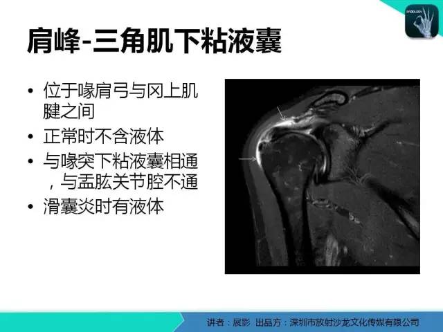 【PPT】肩峰下撞击综合征和肩袖损伤的MR表现