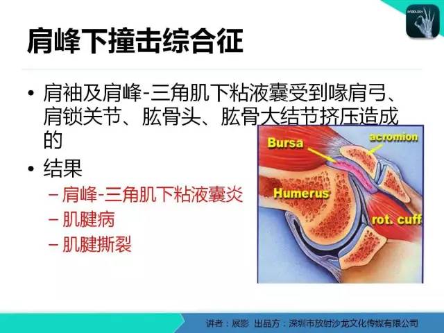【PPT】肩峰下撞击综合征和肩袖损伤的MR表现