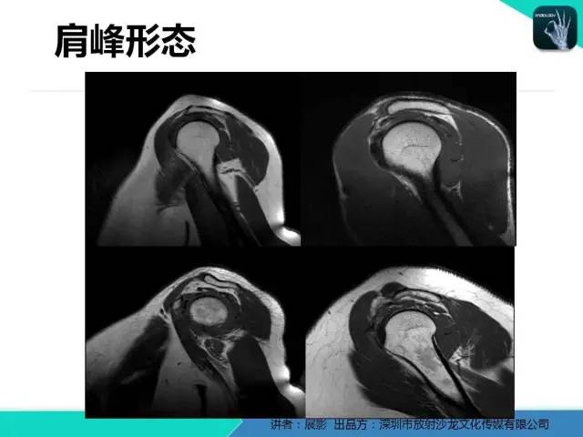 【PPT】肩峰下撞击综合征和肩袖损伤的MR表现