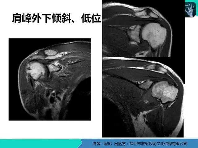 【PPT】肩峰下撞击综合征和肩袖损伤的MR表现
