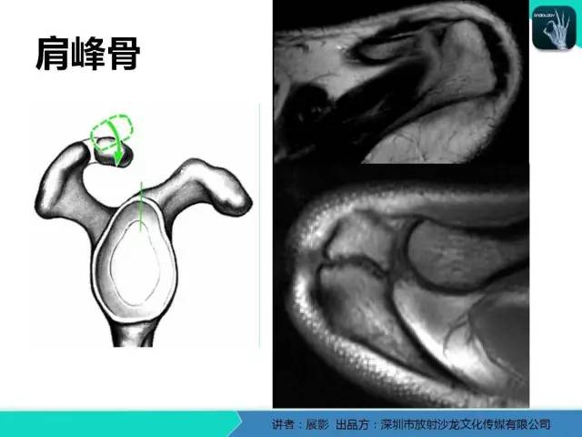 【PPT】肩峰下撞击综合征和肩袖损伤的MR表现