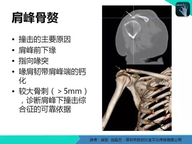 【PPT】肩峰下撞击综合征和肩袖损伤的MR表现