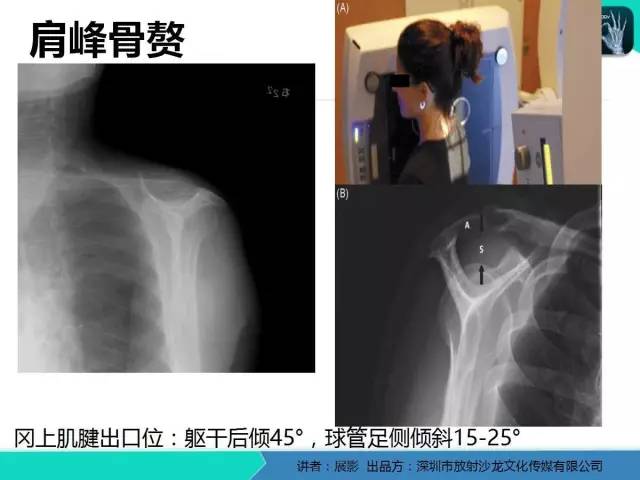 【PPT】肩峰下撞击综合征和肩袖损伤的MR表现