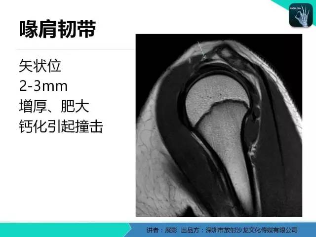 【PPT】肩峰下撞击综合征和肩袖损伤的MR表现