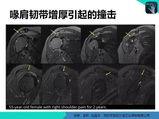 【PPT】肩峰下撞击综合征和肩袖损伤的MR表现