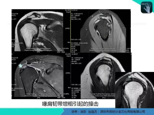 【PPT】肩峰下撞击综合征和肩袖损伤的MR表现