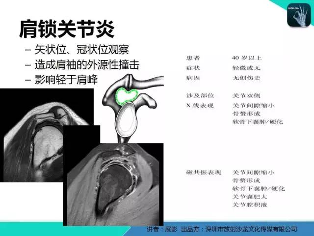 【PPT】肩峰下撞击综合征和肩袖损伤的MR表现