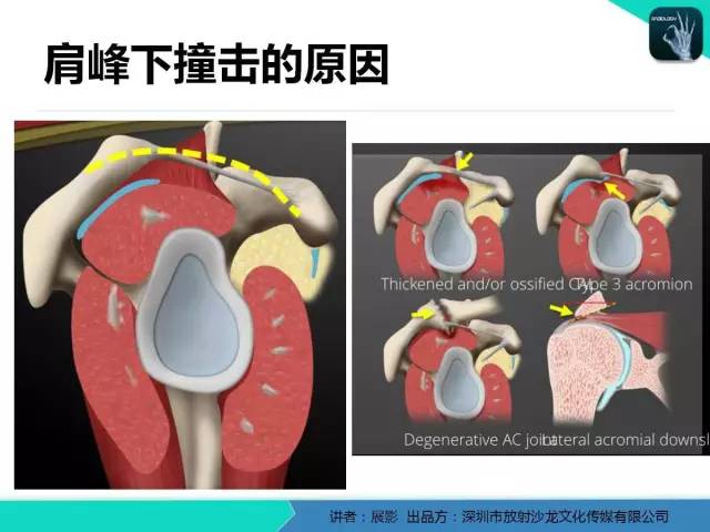 【PPT】肩峰下撞击综合征和肩袖损伤的MR表现