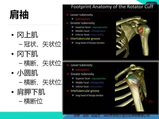 【PPT】肩峰下撞击综合征和肩袖损伤的MR表现