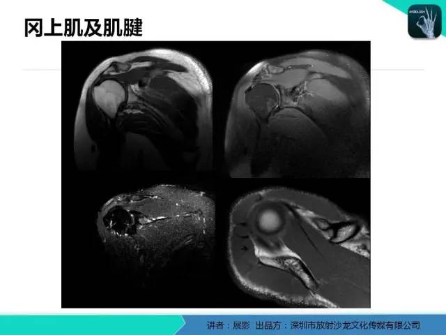 【PPT】肩峰下撞击综合征和肩袖损伤的MR表现
