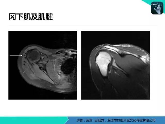 【PPT】肩峰下撞击综合征和肩袖损伤的MR表现