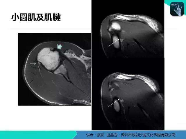 【PPT】肩峰下撞击综合征和肩袖损伤的MR表现