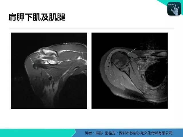 【PPT】肩峰下撞击综合征和肩袖损伤的MR表现